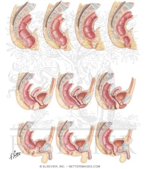 Imperforate Anus