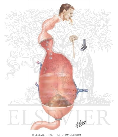 Intestinal Obstruction, Adynamic Ileus