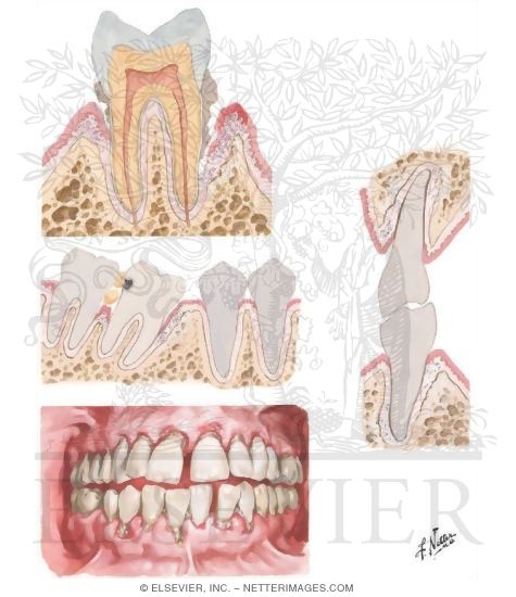 Watermarked preview of unlabeled image: Periodontal Disease