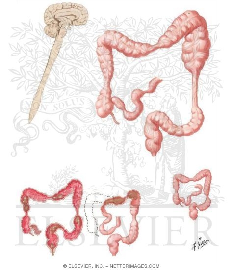Watermarked preview of unlabeled image: Pathophysiology of the Colon