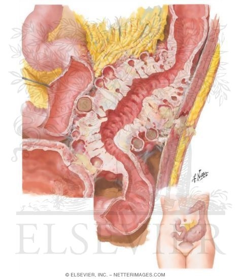 Watermarked preview of unlabeled image: Diverticulitis (Peridiverticular Fibrosis)