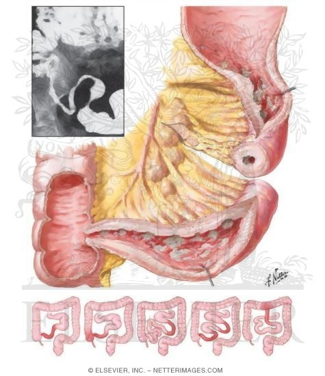 Regional Enteritis (Crohn Disease)