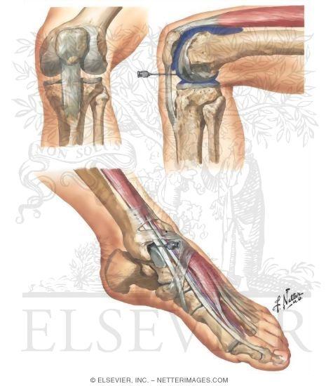 Watermarked preview of unlabeled image: The Knee - The Ankle