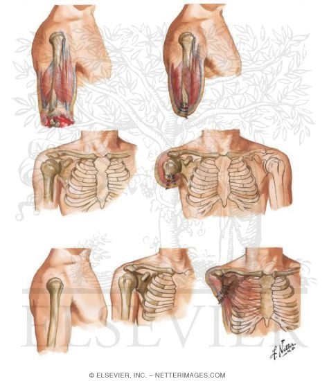 Watermarked preview of unlabeled image: Amputation Through the Humerus - Disarticulation of the Humerus