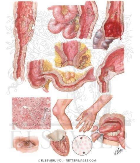 Watermarked preview of unlabeled image: Nonspecific Ulcerative Colitis II - Etiologic Factors, Complications
