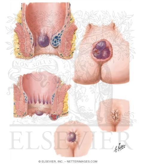 Watermarked preview of unlabeled image: Proctologic Conditions I - Hemorrhoids