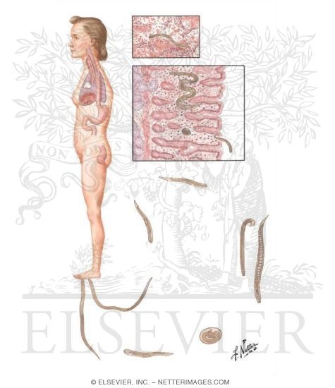 Watermarked preview of unlabeled image: Parasitic Diseases IV - Strongyloidiasis