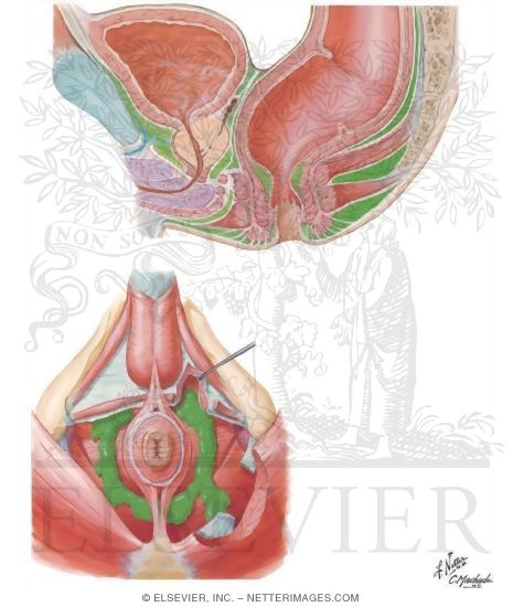 Actual and Potential Perineopelvic Spaces
Pelvic Fascia and Perineopelvic Spaces
Perineopelvic Spaces