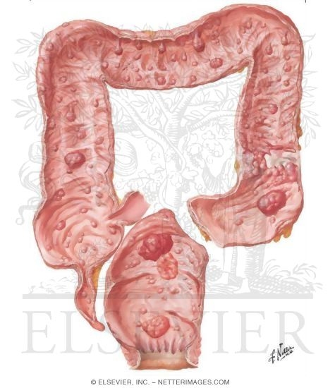 Watermarked preview of unlabeled image: Familial Polyposis of Large Intestine