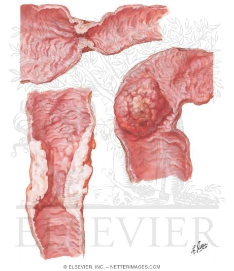 Watermarked preview of unlabeled image: Malignant Tumors of Large Intestine