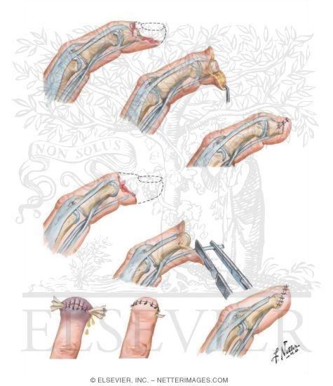 Amputation of Phalanx