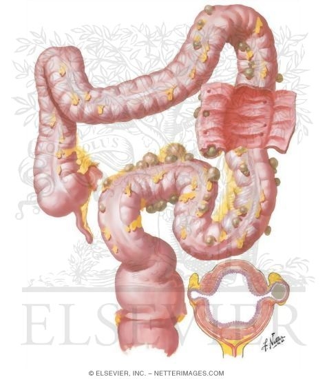 Diverticulosis   