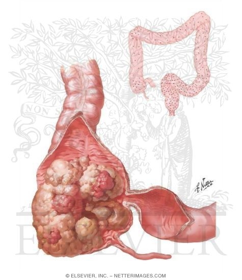 Watermarked preview of unlabeled image: Malignant Tumors of Large Intestine