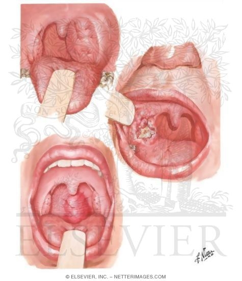Malignant Tumors of Fauces and Oral Pharynx