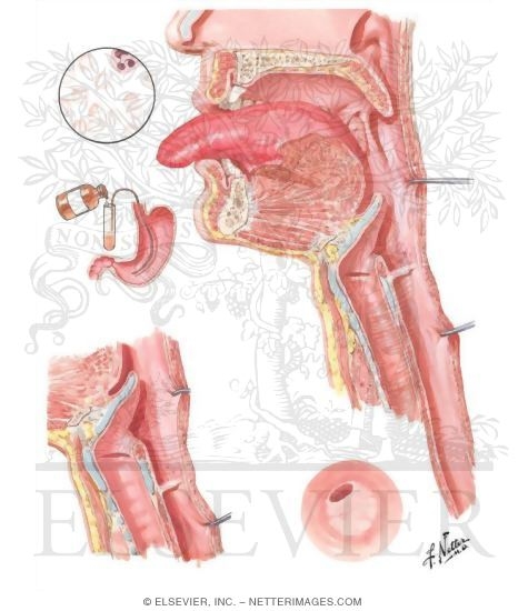 Plummer-Vinson Syndrome