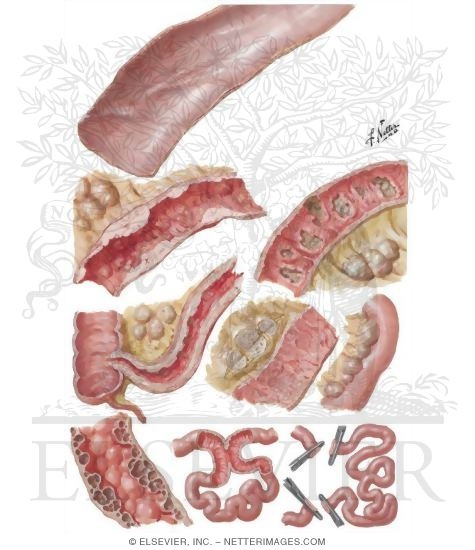 Enterogenous Malabsorption Syndrome (Sprue Syndrome)