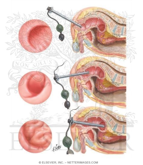 Sigmoidoscopy