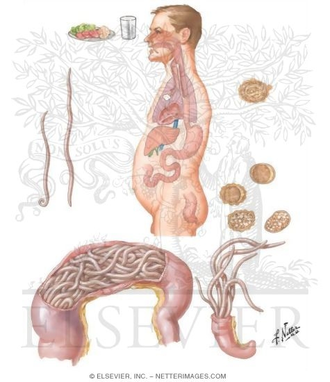 Parasitic Diseases II - Ascariasis