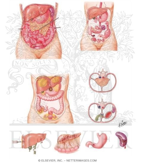 Acute Peritonitis