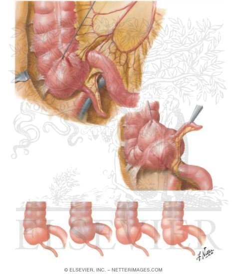Ileocecal Region