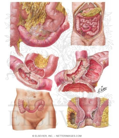 Regional Enteritis (Crohn Disease)