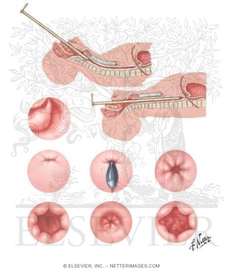 Esophagoscopy