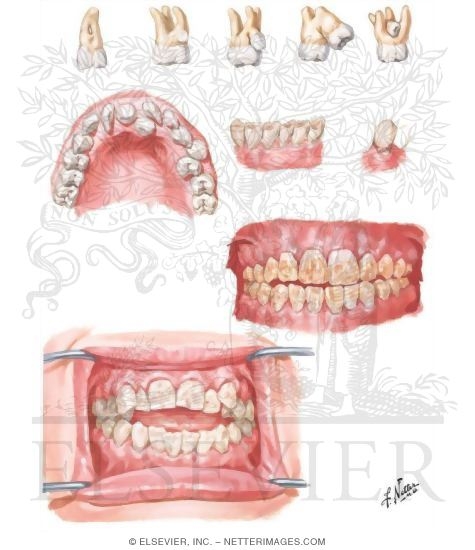 Dental Abnormalities