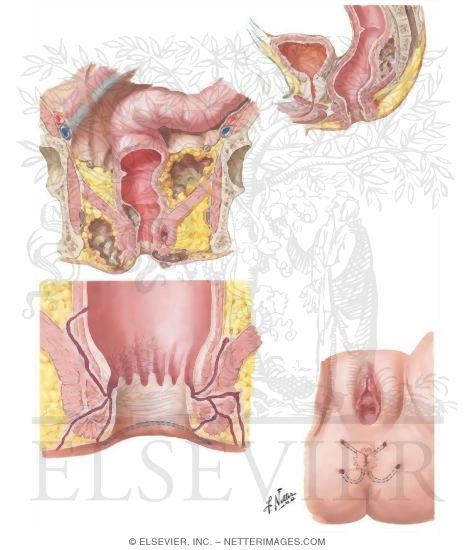 Proctologic Conditions IV - Anorectal Abscess and Fistula