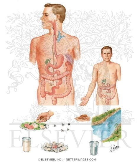 Watermarked preview of unlabeled image: Enteric (Typhoid, Paratyphoid) Fever: Epidemiology and Pathogenesis