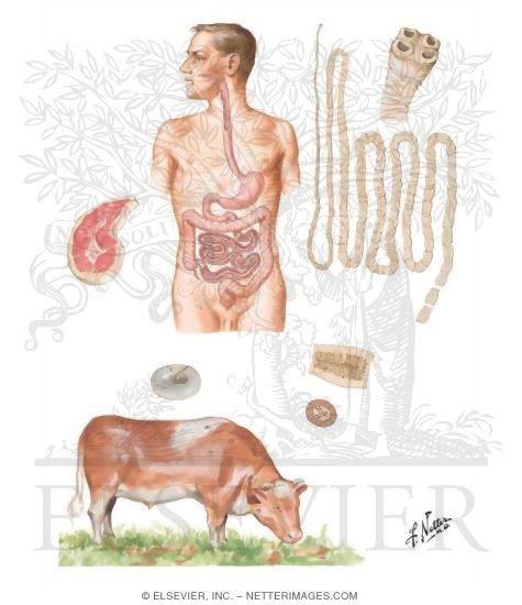 Watermarked preview of unlabeled image: Parasitic Diseases VI - Taeniasis Saginata