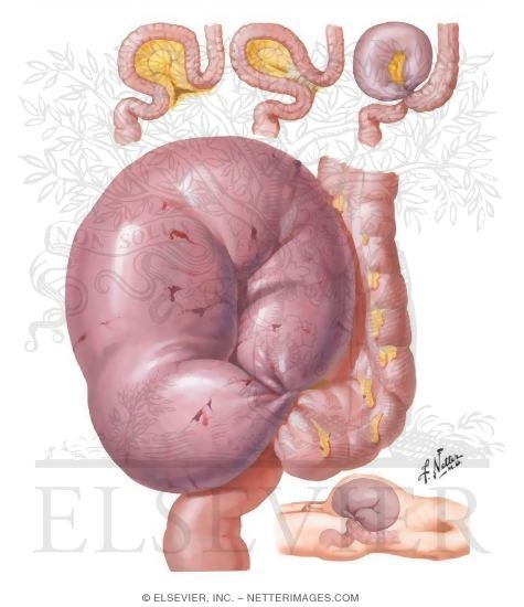 Volvulus of the Sigmoid