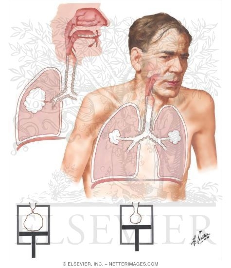 Westminster Village West Lafayette - Do you have COPD? Breathing exercises  for COPD can help you strengthen breathing muscles, get more oxygen with  each breathe, and breathe with less effort. One breathing