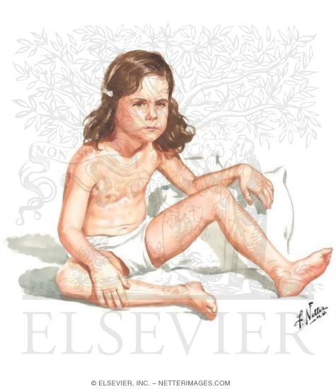 Watermarked preview of unlabeled image: Acute Febrile Juvenile Rheumatoid Arthritis (JRA): Common Physical Findings, Fever Pattern, and ECG of Pericarditis