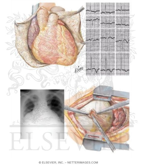 Watermarked preview of unlabeled image: Diseases of Pericardium