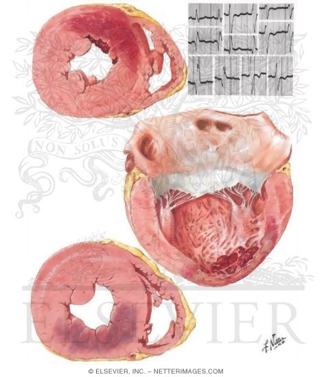 Watermarked preview of unlabeled image: Arteriosclerotic Heart Disease