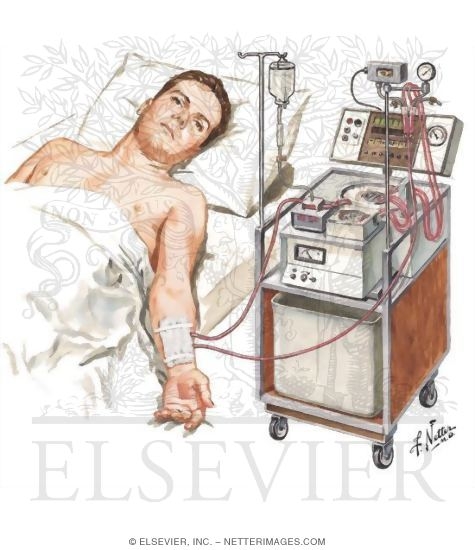 Hemodialysis in Progress
