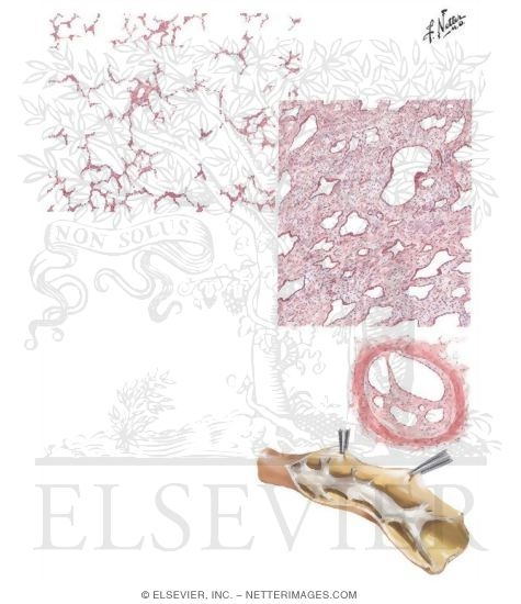 Watermarked preview of unlabeled image: Chronic Cor Pulmonale