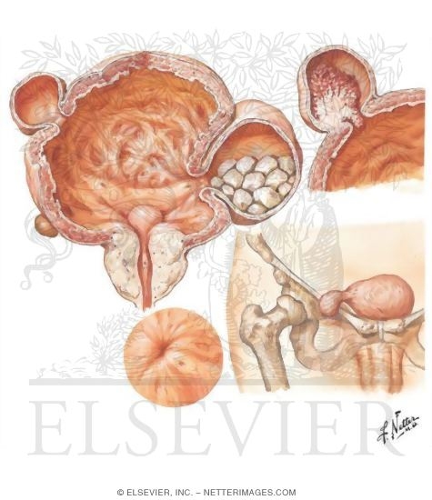 Diverticula of the Urinary Bladder