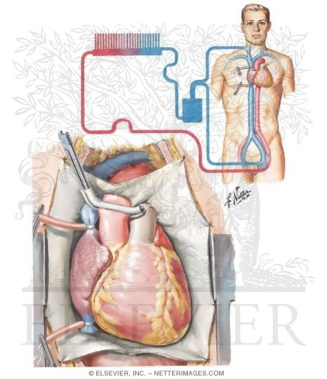 Heart Transplantation