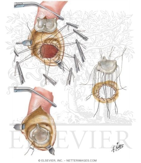 Watermarked preview of unlabeled image: Insertion of Trileaflet Aortic Valve