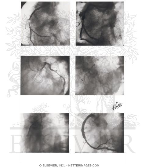 Watermarked preview of unlabeled image: Surgery for Coronary Artery Disease - Arteriograms