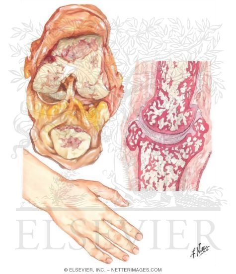 Pathology of Osteoarthritis and Joints Usually Involved