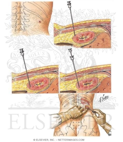 Watermarked preview of unlabeled image: Renal Biopsy