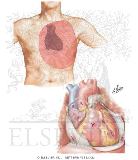 Penetrating Heart Wounds