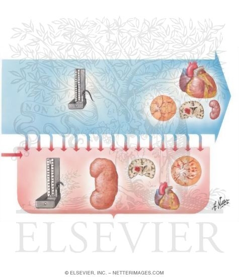 Benign essential store hypertension