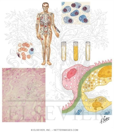 Myelomatosis With Renal Involvement