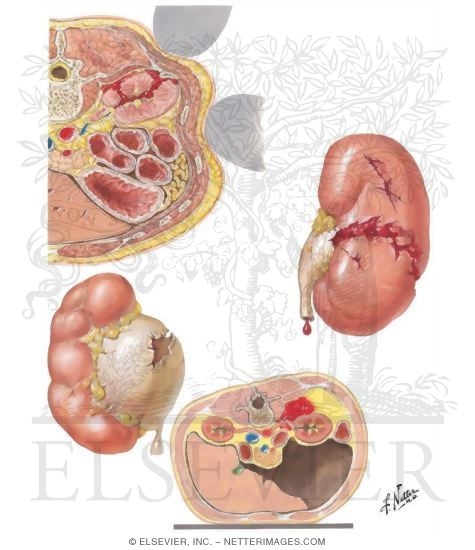 Watermarked preview of unlabeled image: Renal Trauma - Nonpenetrating Trauma of Kidney