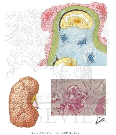 Chronic Glomerulonephritis