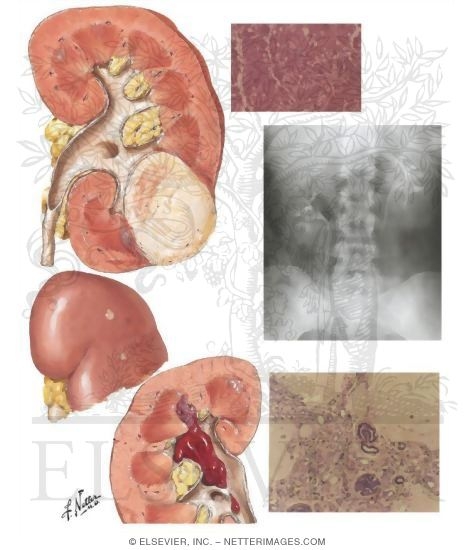 Benign Tumors of the Kidneys