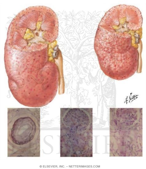 Malignant Phase of Essential Hypertension: Renal Pathology